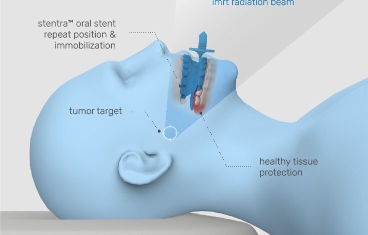 RICOH 3D for Healthcare and Kallisio 3D print 'Stentra' to enhance radiation oncology care for head and neck cancer (HNC) patients.