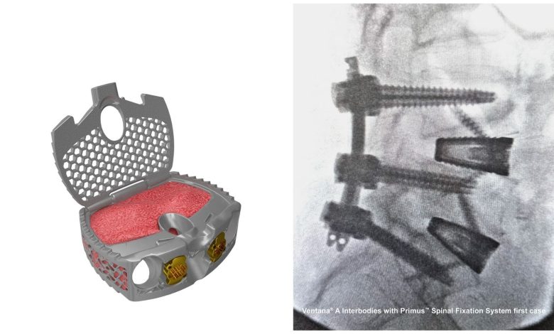 Spinal Elements gets FDA clearance for Ventana A anterior lumbar fusion system