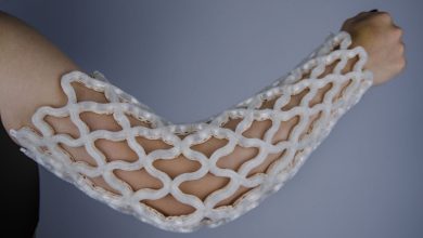 Castomize’s heat-molded 3D printed orthopedic cast has reduced costs by up to 25%