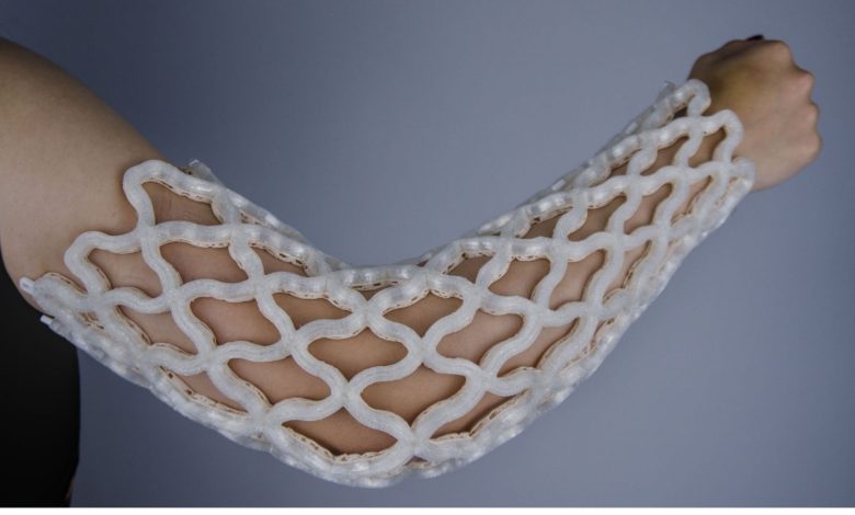 Castomize’s heat-molded 3D printed orthopedic cast has reduced costs by up to 25%