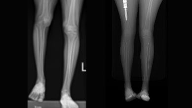 Hadassah doctors rebuild and lengthen leg using 3D printed implants