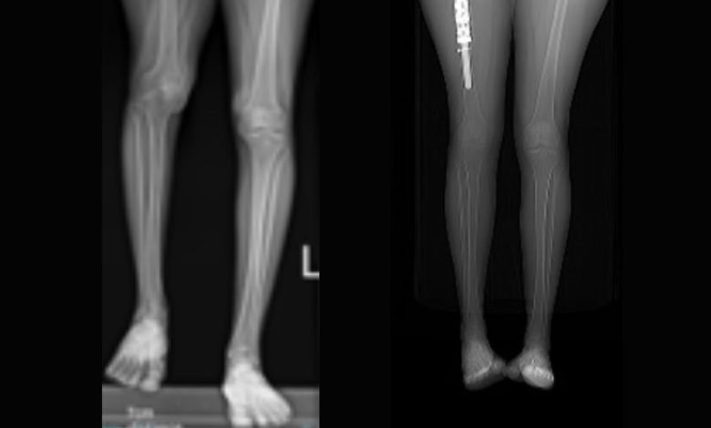 Hadassah doctors rebuild and lengthen leg using 3D printed implants