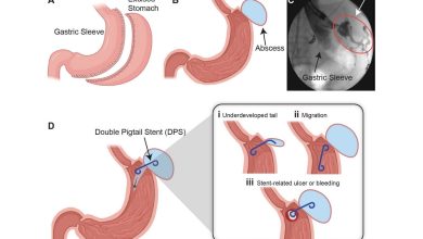 3D printed stents outperform commercial devices in gastric leak study