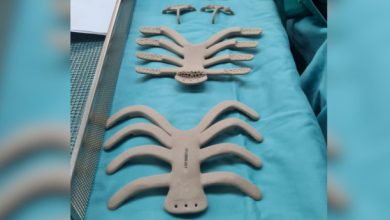 Clalit-Beilinson Hospital reconstructs a patient's chest wall with a 3D printed implant